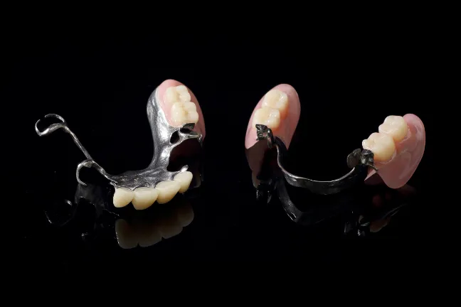 歯をたくさん失った場合従来の方法