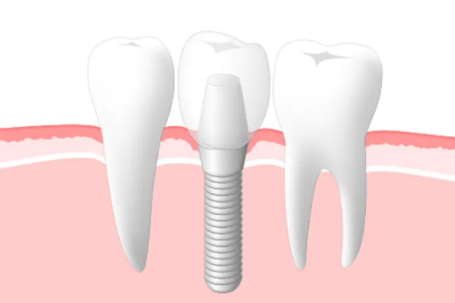 歯を1本失ってしまった場合インプラント
