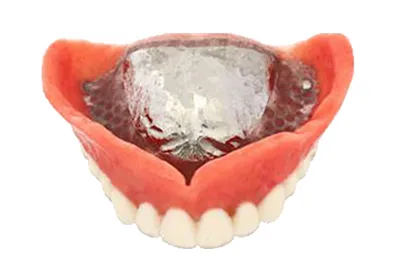 各種金属床義歯