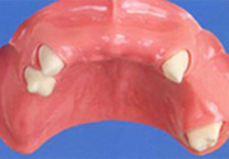 コーヌステレスコープ義歯