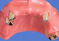 コーヌステレスコープ義歯