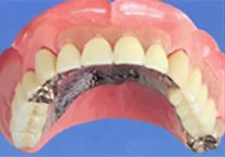 コーヌステレスコープ義歯