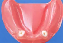 磁性アタッチメント義歯