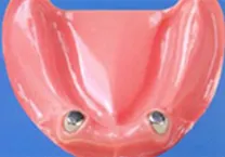 磁性アタッチメント義歯