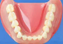 磁性アタッチメント義歯